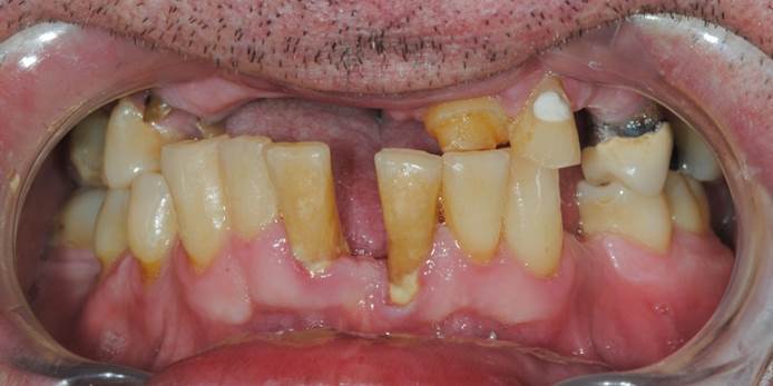 Lost teeth replaced with Dental Implants